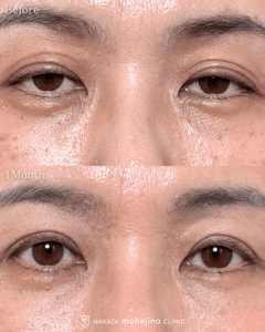 眼瞼下垂症手術(挙筋腱膜前転法)