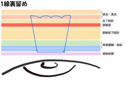 「裏留め」埋没法