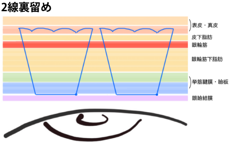 「裏留め」埋没法