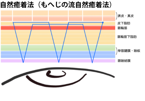 自然癒着法（もへじの流自然癒着法）