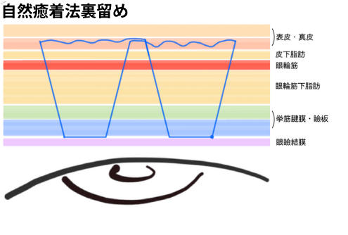 自然癒着法裏留め